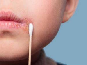 Лечение герпеса на губах народными средствами в домашних условиях