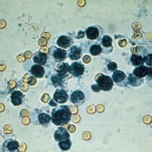 На что указывают лейкоциты в кале: расшифровка копрограммы