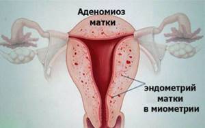 Разрастание эндометрия матки