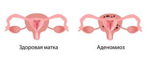 Эндометриоз матки (аденомиоз)