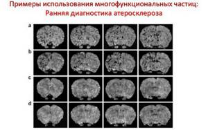 Диагностика атеросклероза сосудов головного мозга