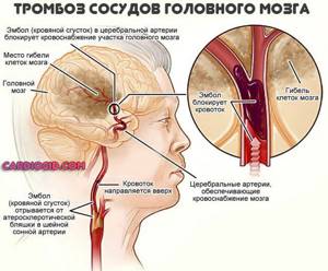 тромбоз-сосудов-головного-мозга