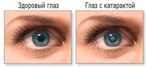 Симптомы катаракты