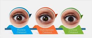 Типы катаракты по локализации