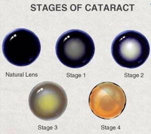 Стадии развития катаракты