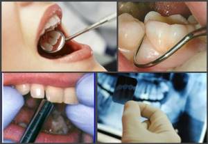 Что такое пульпит зуба: причины возникновения, симптомы и лечение