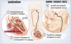 тромбоэмболия головного мозга