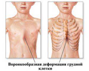 Деформация грудной клетки: степени, причины, лечение. Воронкообразная и килевидная деформация грудной клетки