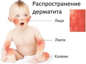 Мази от дерматита на коже у взрослых. Самые эффективные