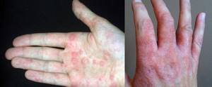 Дерматит на коже: лечение мазями и кремами в домашних условиях