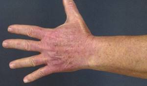Дерматит на коже: лечение мазями и кремами в домашних условиях