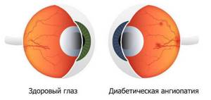 Диабетическая ангиопатия сосудов сетчатки глаза - признаки и ...