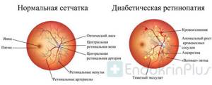 поражение глаза при диабетической ретинопатии