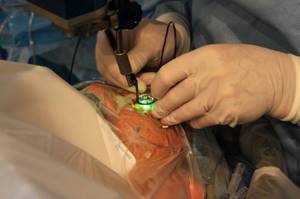 Лазерное лечение диабетической ретинопатии
