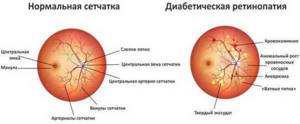 стадии диабетической ретинопатии