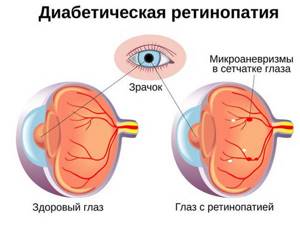 Признаки диабетической ретинопатии