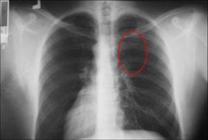 Диагностика туберкулеза легких на рентгеновских снимках (фото)