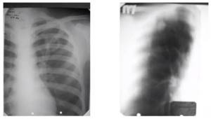 Инфильтративный туберкулез на рентгене