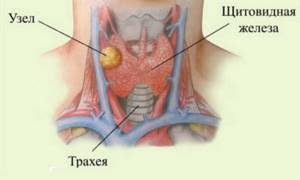 Насколько опасны небольшие узлы в щитовидной железе?