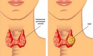 Чем может быть опасен узел на щитовидной железе
