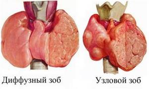 Отличия диффузного и узлового зоба щитовидной железы