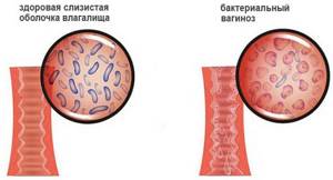 Дисбиоз с преобладанием условно патогенных анаэробных микроорганизмов кишечника, в гинекологии: выраженный, умеренный