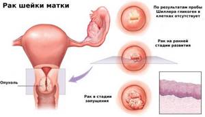 Дисплазия шейки матки — степени развития заболевания и методы лечения