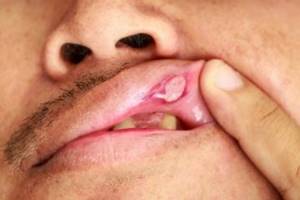 Средства для профилактики и лечения язвы во рту