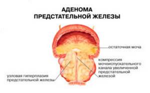 Симптомы аденомы предстательной железы