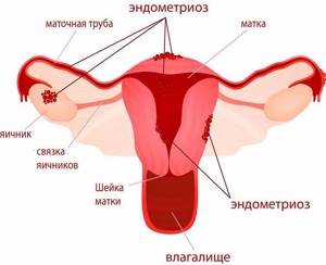 Что такое эндометриоз?