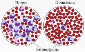 Эозинофилы в крови повышены, какая норма, причины увеличения результата анализа у детей, взрослых