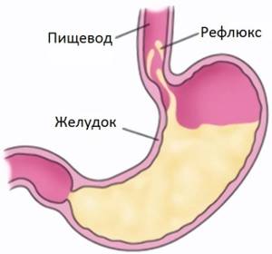 Ларингофарингеальный рефлюкс — симптомы, диагностика, лечение