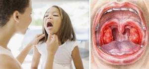 Фолликулярная ангина — симптомы, лечение у детей и взрослых