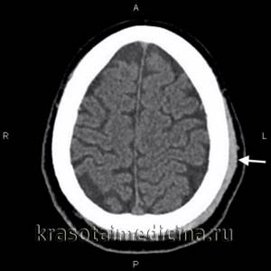 КТ головного мозга. Гематома периферических мягких тканей левой теменной области