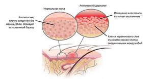 Мазь для лечения атопического дерматита