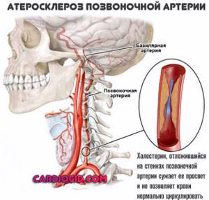 атеросклероз-позвоночной-артерии