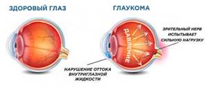 Глаукома рисунок