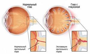 Развитие глаукомы - атрофия зрительного нерва