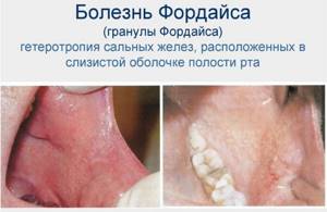 Гранулы Фордайса на губах. Фото, причины, симптомы, лечение, как избавиться