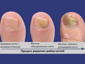 Грибок ногтей — виды, описание лечения, какие бывают и как избавиться раз и навсегда (120 фото)