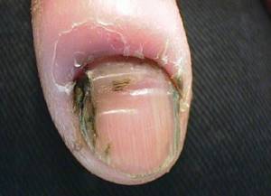 Грибок ногтей — виды, описание лечения, какие бывают и как избавиться раз и навсегда (120 фото)