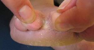грибок на коже между пальцами