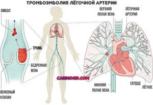 тромбоэмболия-легочной-артерии