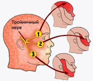 Невралгия тройничного нерва: симптомы и лечение, причины заболевания