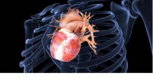 Гипертрофия левого желудочка сердца: что это и как можно лечить