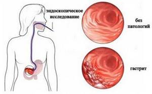 Как лечить желудок и поджелудочную железу перекисью водорода