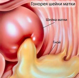 Воспаление уретры у женщин. Симптомы и лечение, народные средства от уретрита