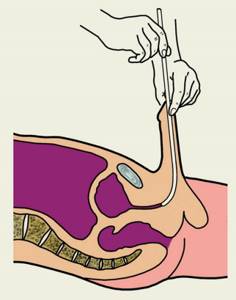 инстилляции в уретру