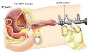 Как проводится цистоскопия мочевого пузыря у женщин
