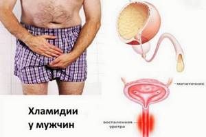 Как проявляется хламидиоз у мужчин: признаки заболевания и методы лечения
